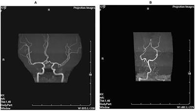 Stormorken Syndrome Caused by a Novel STIM1 Mutation: A Case Report